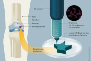 Bio-3D-Druck mit körpereigenen Knorpelzellen sorgt für starke Knie