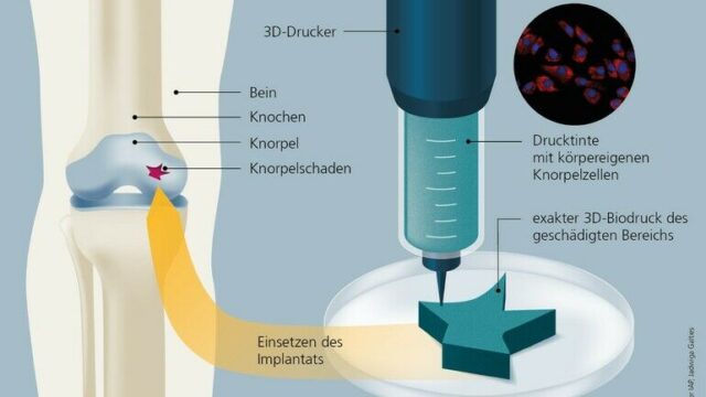 Bio-3D-Druck mit körpereigenen Knorpelzellen sorgt für starke Knie