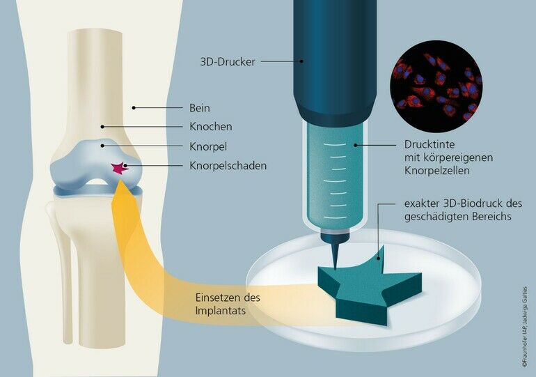 Bio-3D-Druck mit körpereigenen Knorpelzellen sorgt für starke Knie