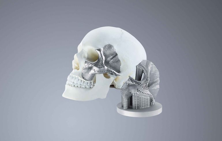 3D-gedruckte Implantate für die halbe Welt